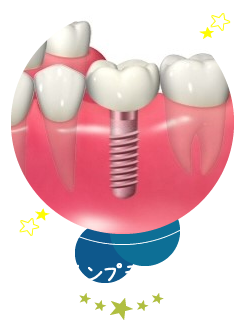 インプラント