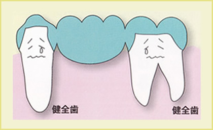 歯が中間で1本抜けた場合（ブリッジ）