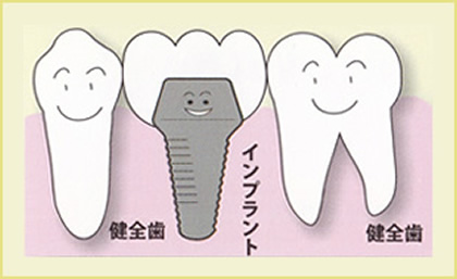 歯が中間で1本抜けた場合（ブリッジ）