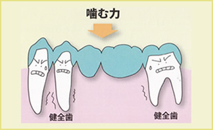 歯が中間で2本抜けた場合（ブリッジ）