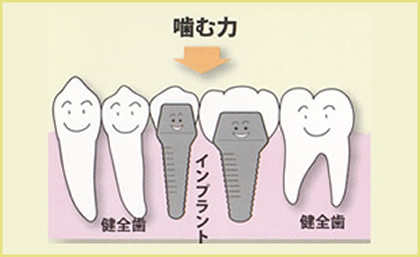 歯が中間で2本抜けた場合（ブリッジ）