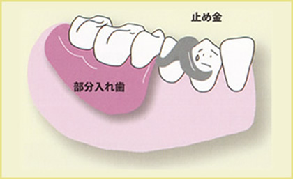 奥歯が数本抜けた場合（局部床義歯＝部分入れ歯）