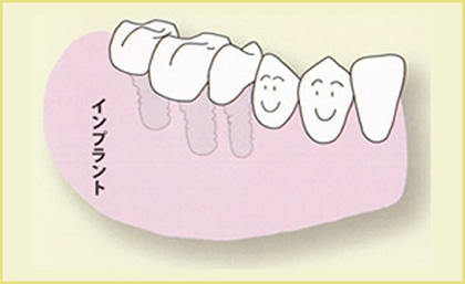 奥歯が数本抜けた場合（局部床義歯＝部分入れ歯）