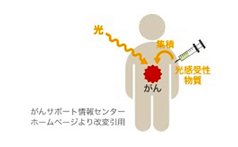 医科では早期がんの治療法として