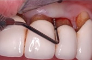 重度歯周病（歯槽膿漏）