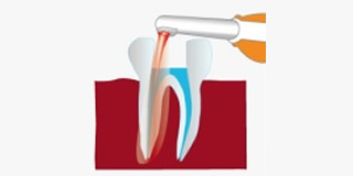 根の治療（感染根管治療）