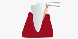 歯槽膿漏（歯周病）